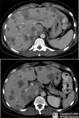 metastatic liver cancer