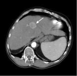 metastatic liver tumor